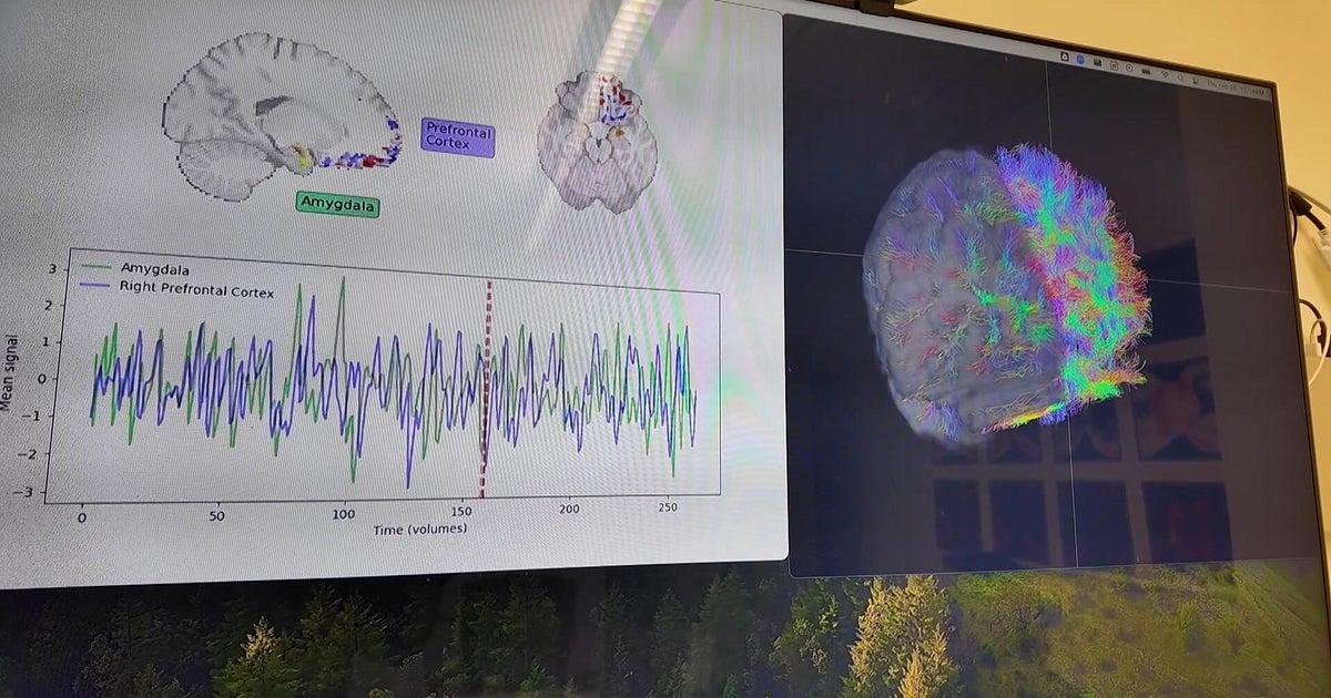 CBS News New York coverage of Mount Sinai stress study brain imaging